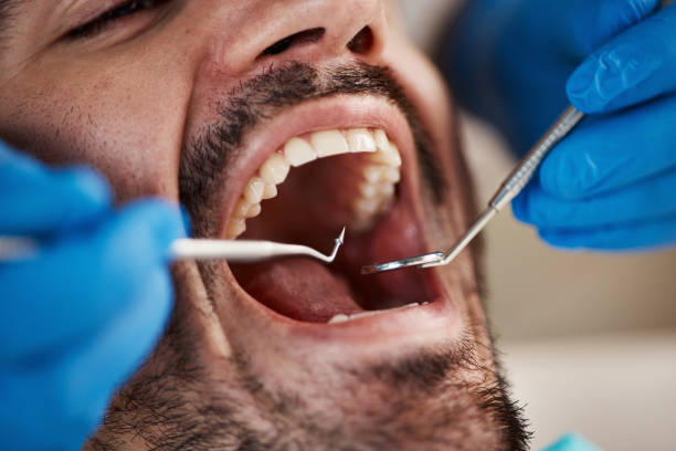 Best Emergency Treatment for Dental Infections or Abscesses in Covgton, IN