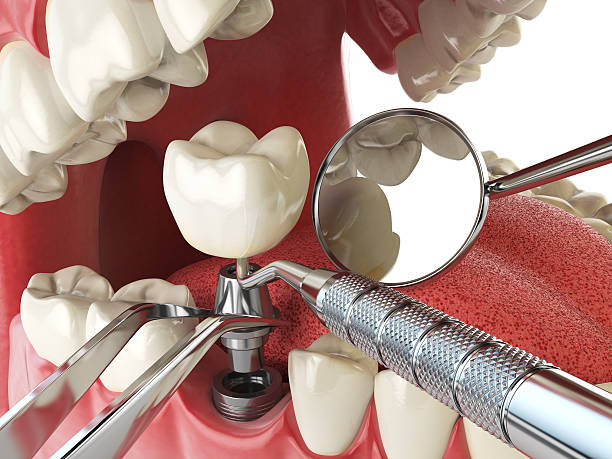 Best Same-Day Emergency Dental Services in Covgton, IN